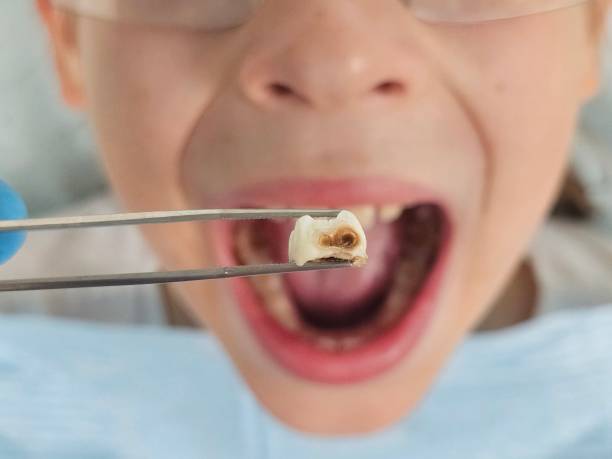 Best Emergency Dental Care for Abscessed Tooth in Baywood Park, CA